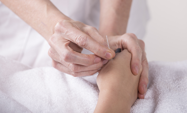 Acupunctuur gunstig bij milde hypertensie