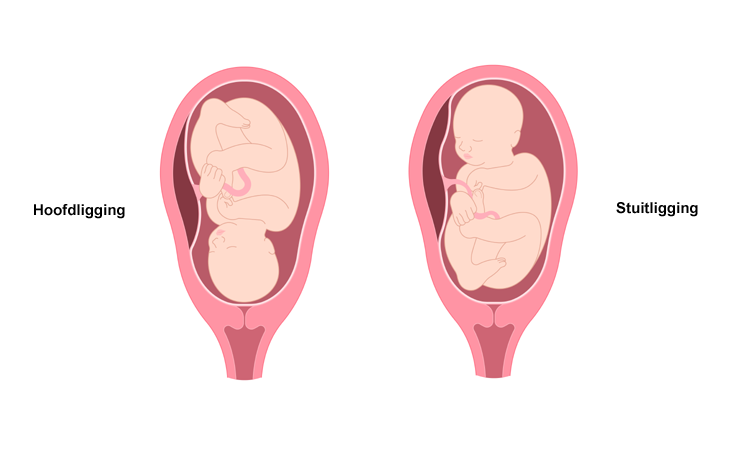 Reflexzonetherapie bij stuitligging
