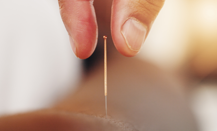 Acupunctuur bij obesitas