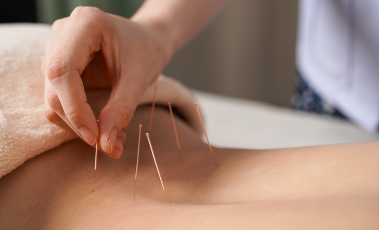 Nederlands onderzoek acupunctuur bij neuropathie van start