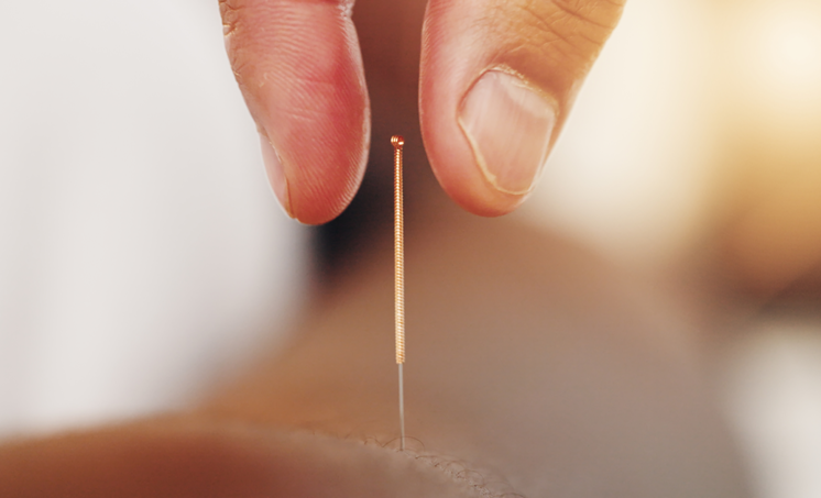 Systematische review: acupunctuurpunttherapie gunstig bij milde cognitieve stoornis