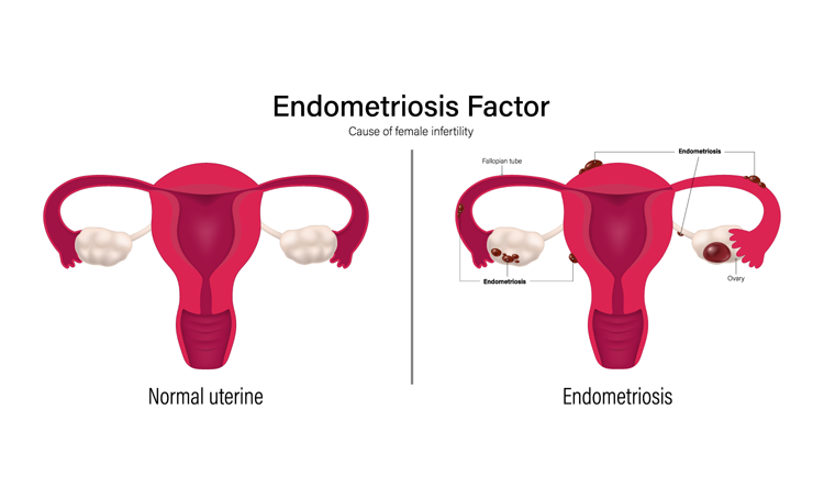 Zwangerschapswens en endometriose